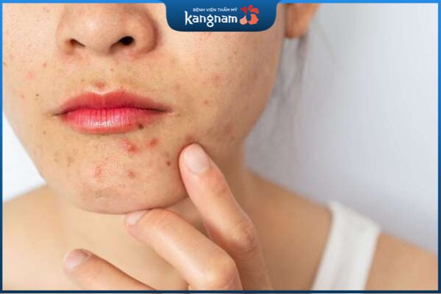 BHA (Salicylic Acid) đã được chứng minh là có khả năng cải thiện tình trạng mụn