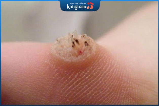 Mụn hạt cơm thường nằm trên một bề mặt không đồng nhất, có gai nhọn