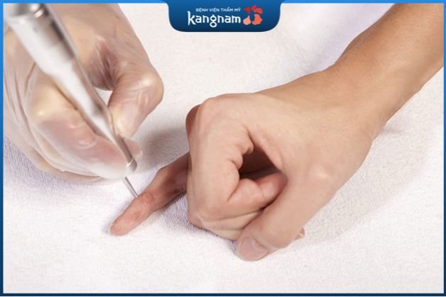 Phương pháp này sử dụng tia laser CO2 để đốt cháy và làm loại bỏ mụn cơm