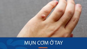Bí quyết loại bỏ mụn cơm ở tay nhanh chóng và an toàn