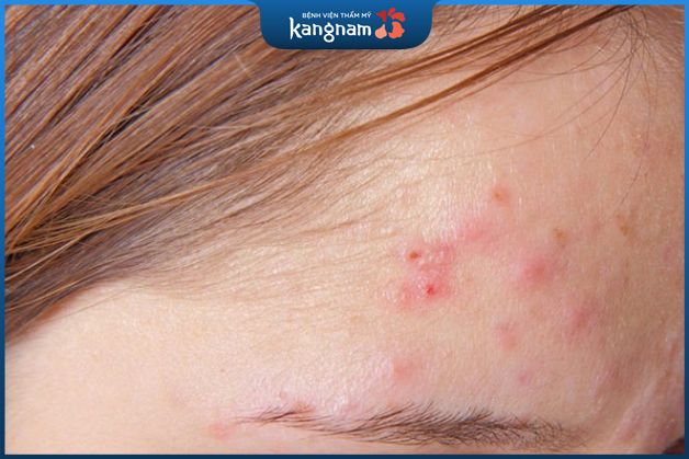 Mụn sưng đỏ thường được gọi là mụn viêm