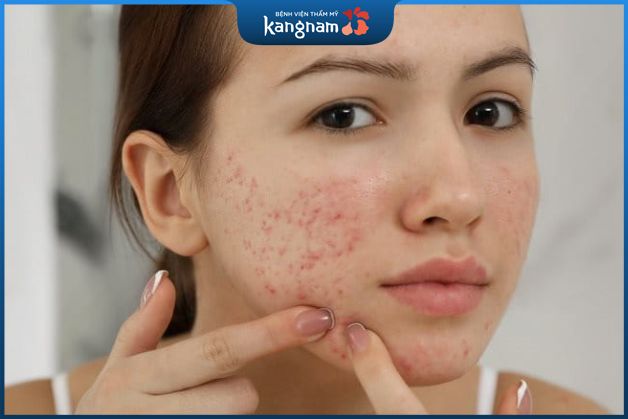 Mụn viêm ở má do bụi bẩn và vi khuẩn