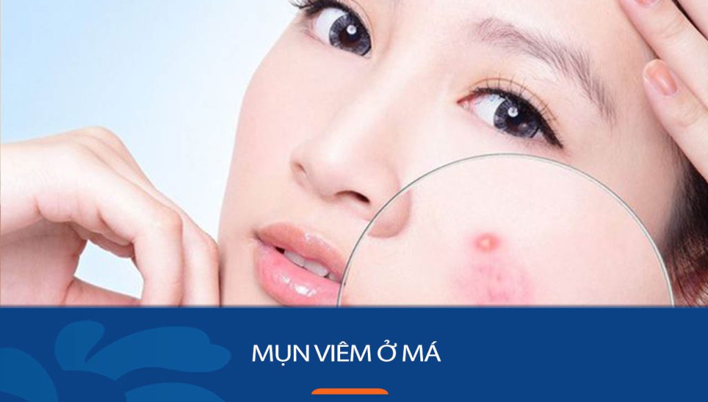 Mụn viêm ở má: Loại bỏ mụn viêm ở má hiệu quả và an toàn