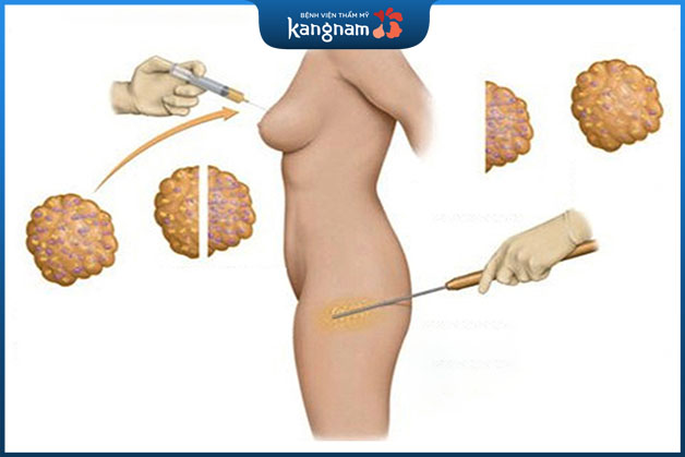 Tế bào mỡ sẽ được lấy từ vùng khác trên cơ thể, sau khi tinh chế sẽ bơm vào ngực