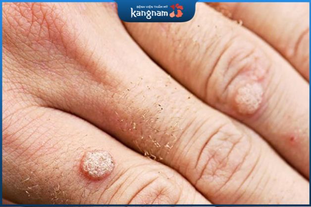 Tỷ lệ mắc bệnh mụn hạt cơm ở trẻ em cao hơn đáng kể so với người lớn