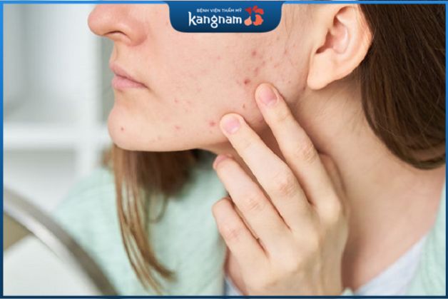 Thiết lập một chế độ chăm sóc da khoa học và đồng đều cho da mụn