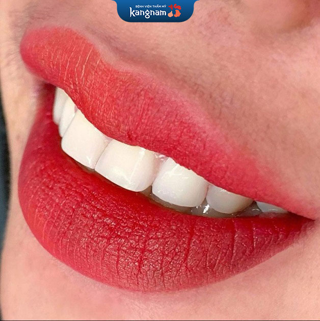 Sở hữu sắc môi tươi giúp răng trắng hơn
