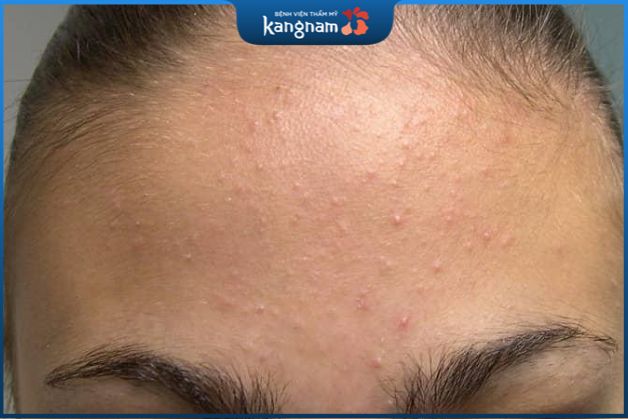 Nếu chăm sóc đúng cách, bạn có thể nhận được kết quả trị mụn tích cực sau khoảng 2-6 tuần