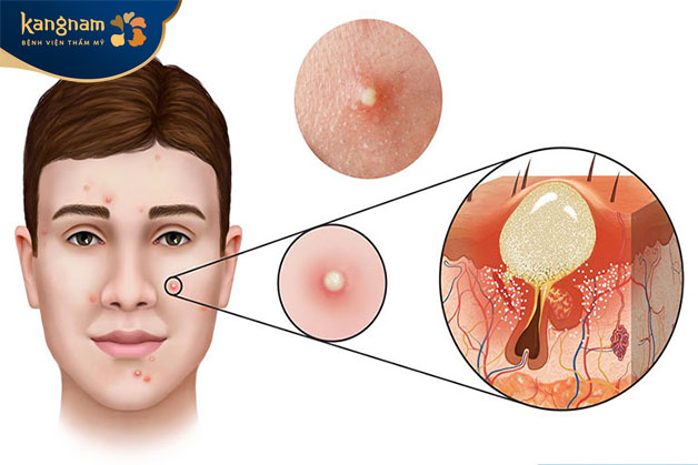 Để tìm cách trị mụn bọc nhanh nhất trong 1 đêm cần biết nguyên nhân hình thành mụn