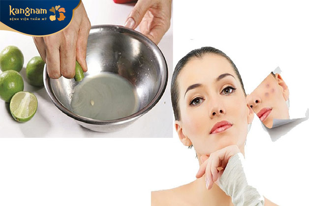 Đắp những lát chanh mỏng lên vùng bị mụn để giảm viêm