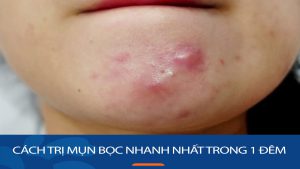 Bật mí cách trị mụn bọc nhanh nhất trong 1 đêm – An toàn, hiệu quả và không tốn kém