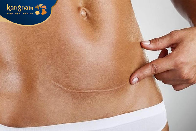 Sau sinh cơ thể mẹ còn yếu dễ bị nhiễm trùng dẫn đến để lại sẹo