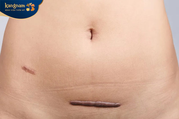 Vết sẹo lồi hẳn trên da bởi cách chăm sóc sau mổ không đúng cách
