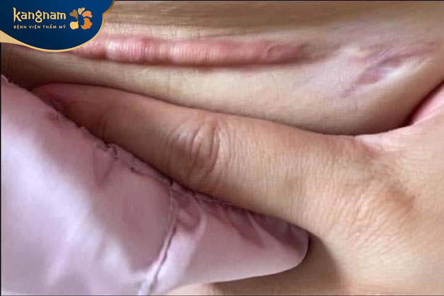 Vết sẹo dài là nổi rõ ở bụng gây mất thẩm mỹ