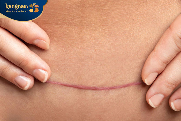 Dù nhỏ nhưng sẹo lồi cũng sẽ gây mất tự tin cho người mẹ