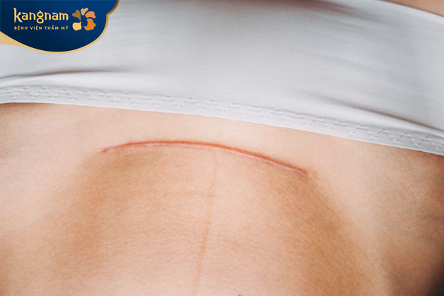 Do cơ địa và yếu tố di truyền rất dễ để lại sẹo