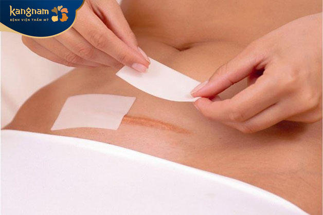 Thay băng và sát khuẩn vết mổ hằng ngày