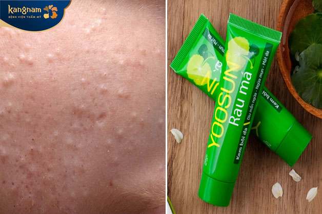 Sản phẩm có thể được sử dụng để điều trị mụn ẩn