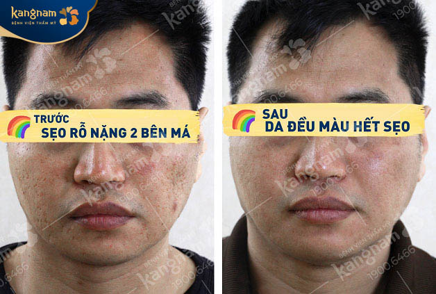 Làn da sẹo rỗ nặng được cải thiện đáng kể