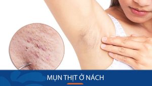 Cách trị mụn thịt ở nách dứt điểm, không tái phát