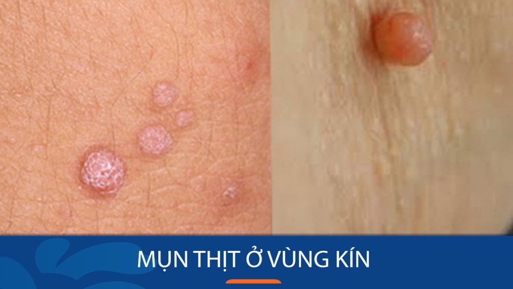 Bí quyết loại bỏ mụn thịt ở vùng kín an toàn và hiệu quả