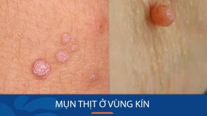 Bí quyết loại bỏ mụn thịt ở vùng kín an toàn và hiệu quả