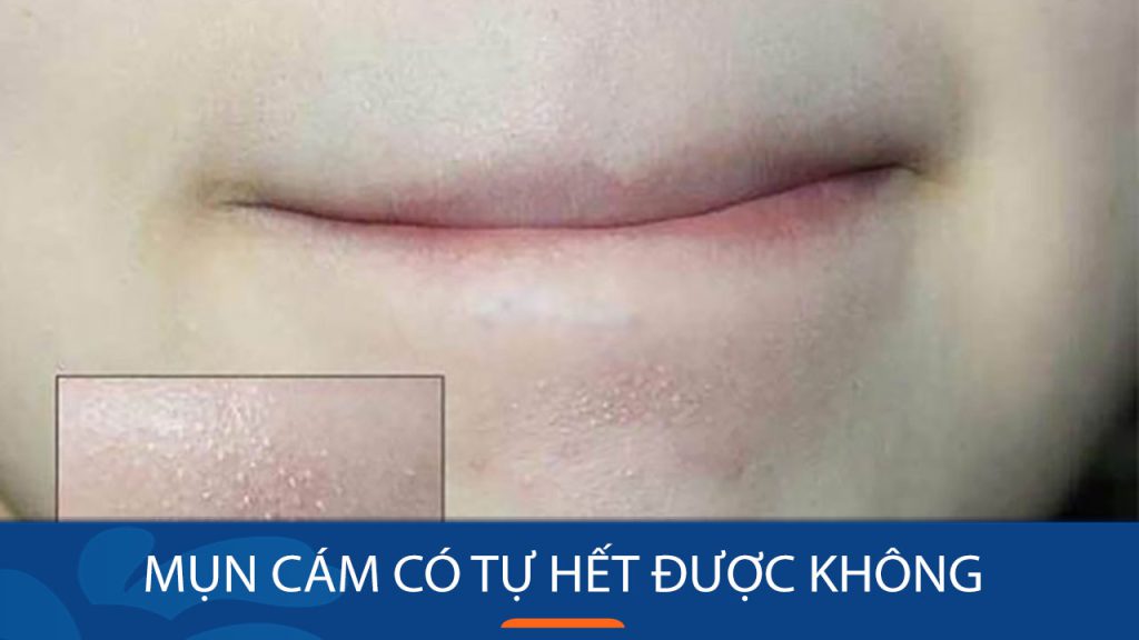 Mụn cám có “tự biến mất”? Bí quyết loại bỏ mụn cám tận gốc từ chuyên gia da liễu