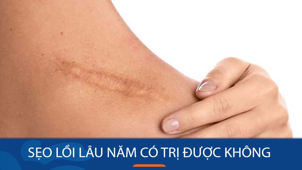 Sẹo lồi lâu năm có trị được không? Loại bỏ hoàn toàn hay chỉ cải thiện?