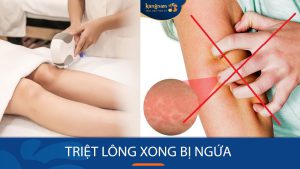 Triệt Lông Xong Bị Ngứa? Đừng Lo, Bí Quyết Hiệu Quả Cho Làn Da Mịn Màng