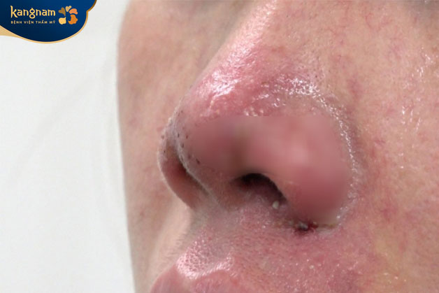 Biến chứng sưng đỏ, bầm tím, đau nhức