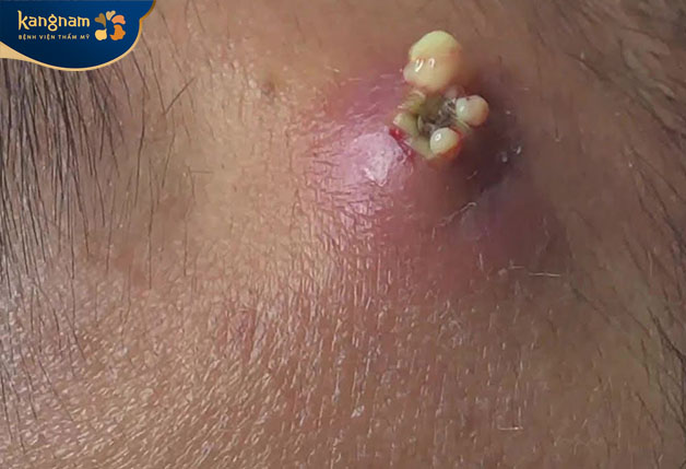 Biến chứng của mụn nhọt