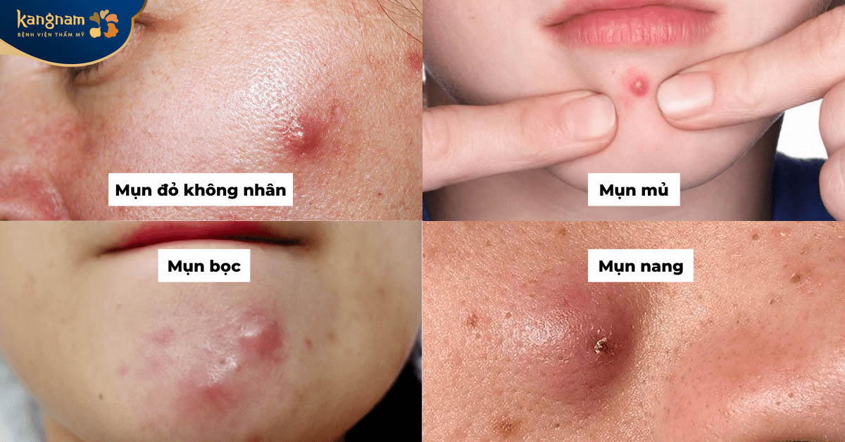 Mụn viêm, mụn bọc sưng đỏ, gây đau khiến nhiều người mất tự tin