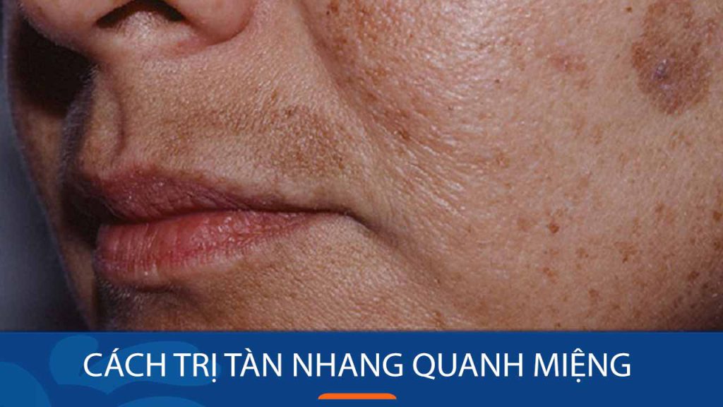 Cách trị tàn nhang quanh miệng hiệu quả, an toàn
