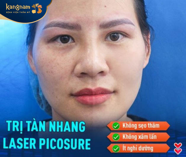 Công nghệ trị tàn nhang tân tiến nhất - laser picosure