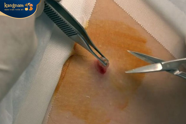 Cắt bỏ mụn thịt cần được thực hiện tại bệnh viện