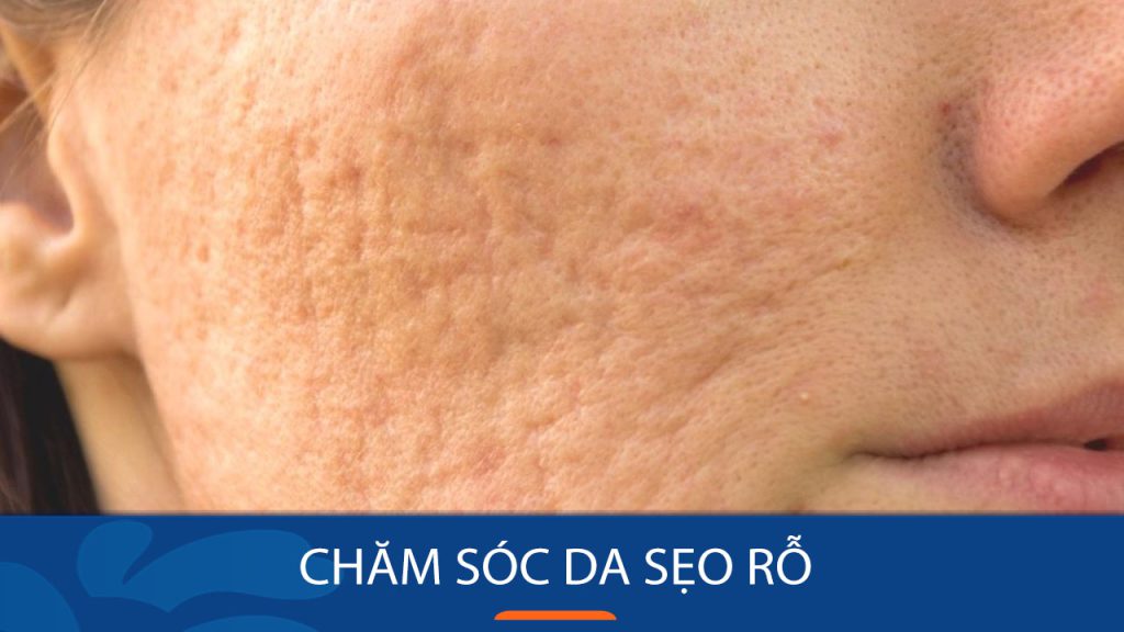 Chăm sóc da sẹo rỗ: Bí quyết đánh bay sẹo rỗ, lấy lại làn da mịn màng