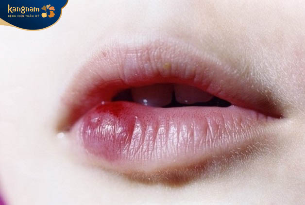 Môi bị nhiễm trùng, phồng rộp