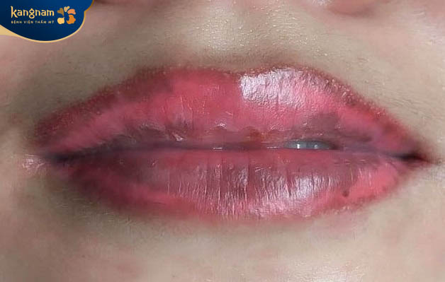 Màu môi không đều, môi bị bầm tím là dấu hiệu của phun môi bị nhiễm trùng