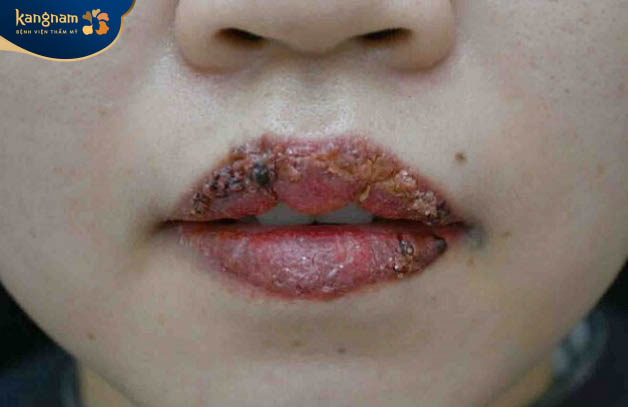 Môi bị nhiễm trùng nặng