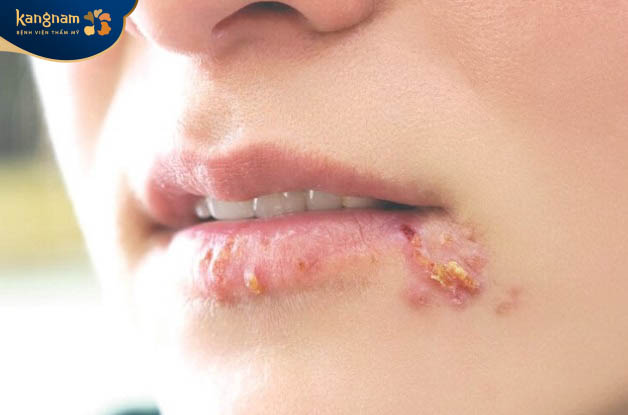 Các nốt mụn nước lan ra các vùng da xung quanh