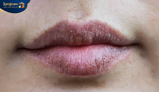 Môi khô và thâm xạm