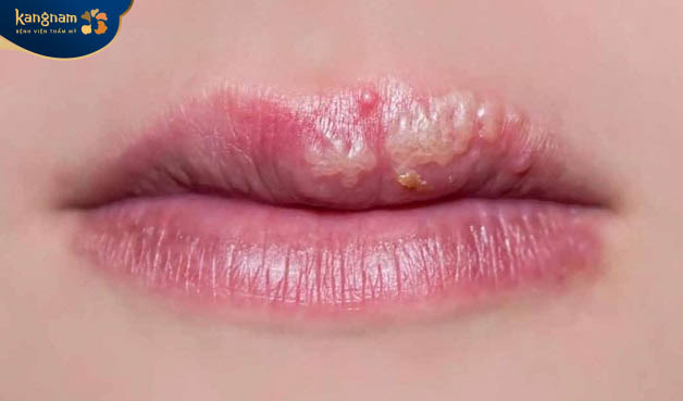 Môi có xuất hiện mụn nước sau phun môi có thể là một trong các dấu hiệu của phun môi bị nhiễm trùng