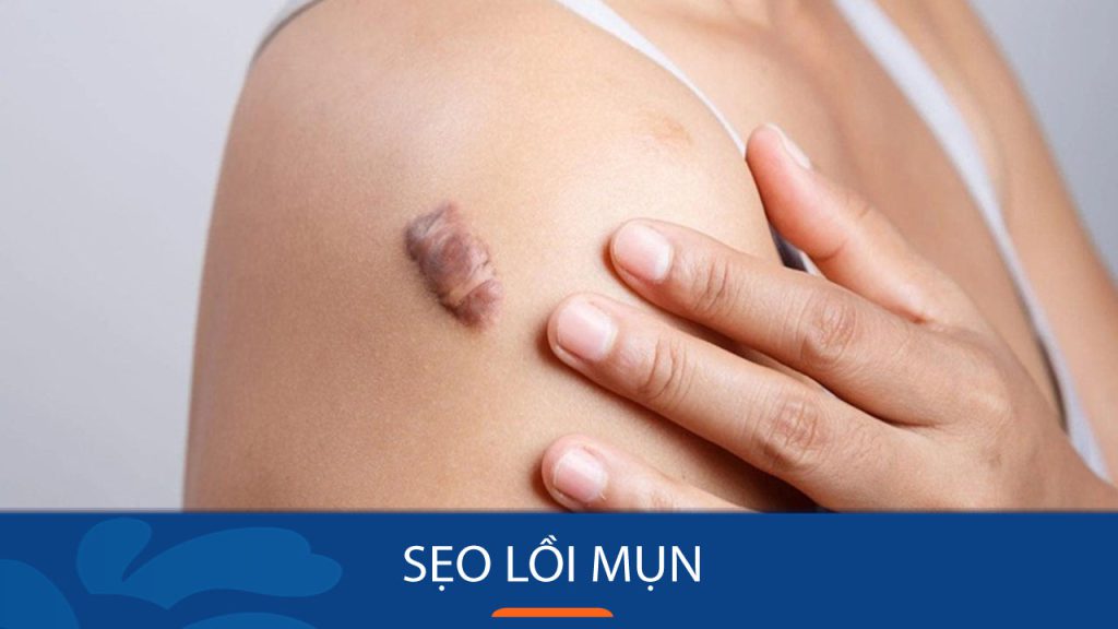 Sẹo lồi mụn: Bí quyết loại bỏ sẹo lồi mụn tận gốc, trả lại làn da mịn màng