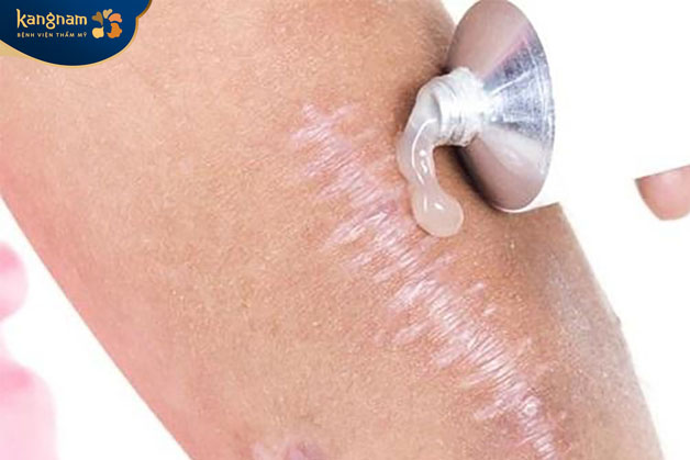 Dùng kem trị sẹo có chứa thành phần như silicone, axit hyaluronic