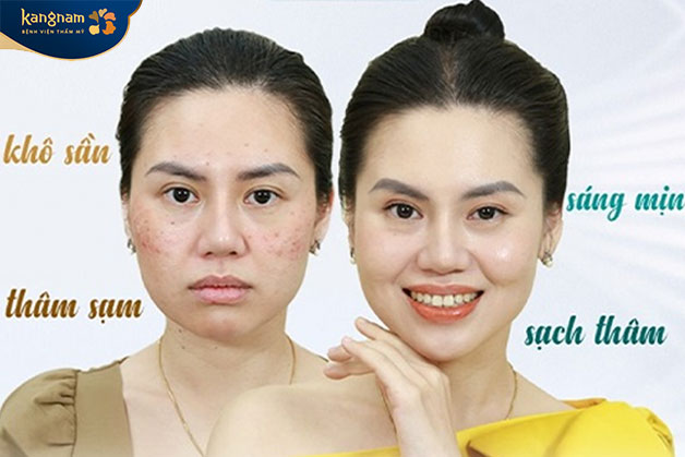 Lựa chọn địa chỉ tiêm meso uy tín, chất lượng