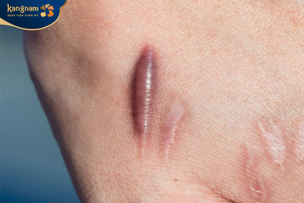 Sẹo lồi có đặc điểm và sưng và nổi cao hơn so với bề mặt da xung quanh