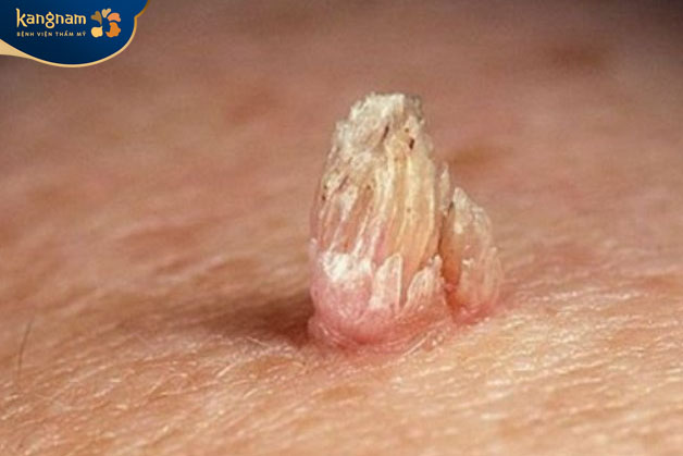 Mụn thịt đầu trắng và khô