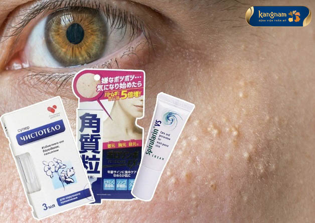 Kem trị mụn thịt có hiệu quả không? Các loại kem trị mụn thịt được ưa chuộng nhất