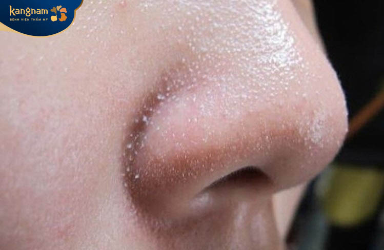 Tình trạng mặt nhiều mụn cám lỗ chân lông to