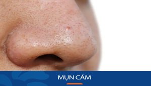 Bí Quyết Loại Bỏ Mụn Cám Vĩnh Viễn: Tạm Biệt Lỗ Chân Lông To & Da Sần Sùi